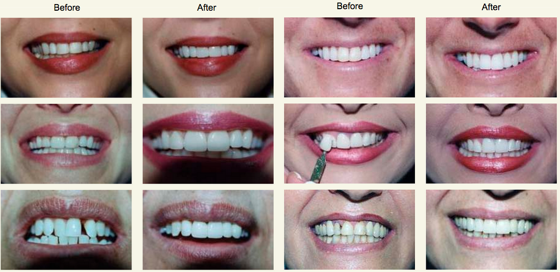 Advance Dental Center Before and After