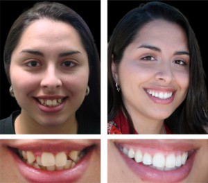 before-after-teeth